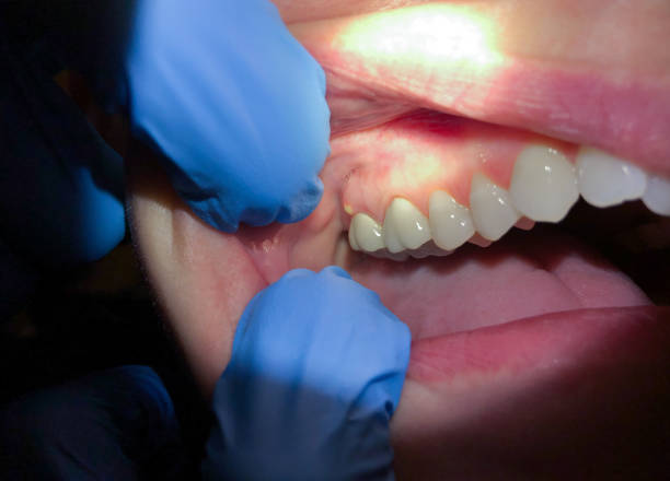 Best Emergency Tooth Extraction in Live Oak, TX